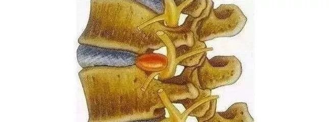 腰间盘突出?椎管狭窄?1根艾条+1个动作=1月搞定! - 第2张 腰间盘突出?椎管狭窄?1根艾条+1个动作=1月搞定! - 第2张