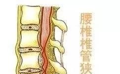腰间盘突出?椎管狭窄?1根艾条+1个动作=1月搞定! - 第3张 腰间盘突出?椎管狭窄?1根艾条+1个动作=1月搞定! - 第3张