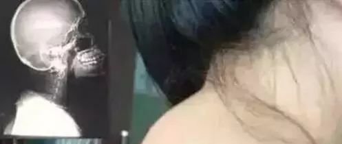 大椎穴,不可不知的人体小太阳,灸一穴通七经 - 第5张 大椎穴,不可不知的人体小太阳,灸一穴通七经 - 第5张